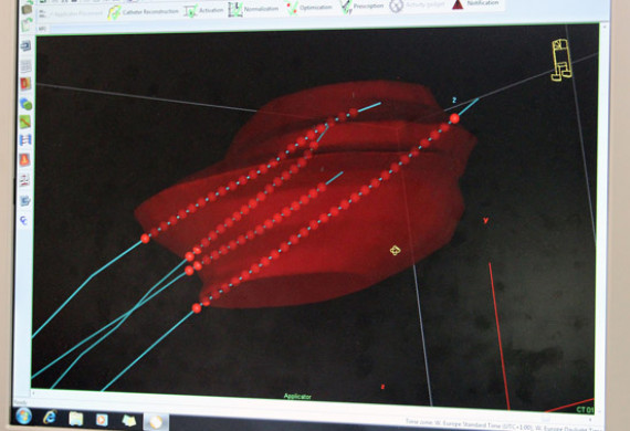 3D-Ansicht des Zielgebietes mit Bestrahlungssonden: Für jede festgelegte Position der Punktquelle (rote Kreise) wird mittels der Standzeiten die Bestrahlungsdosis festgelegt.